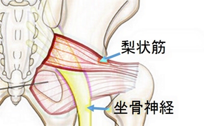 梨状筋症候群の図