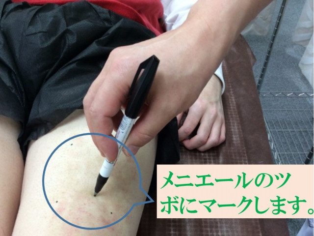 メニエール ツボにマークします