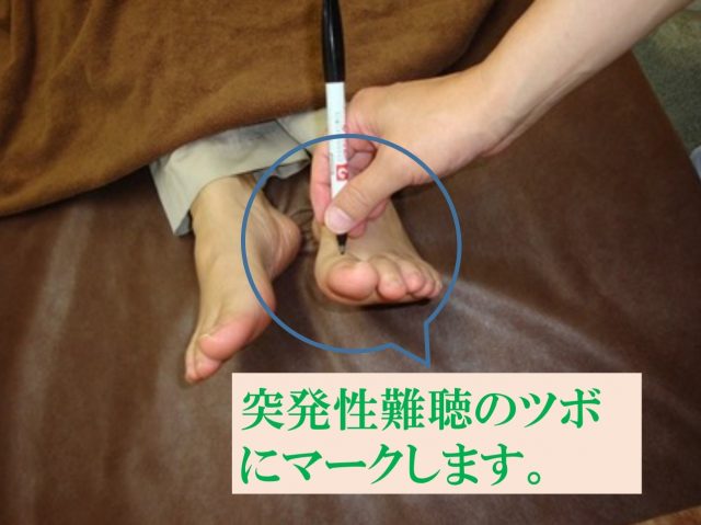 突発性難聴 ツボにマークします。